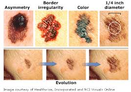 types of melanoma